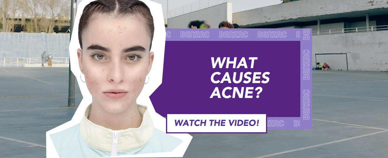 Video Cover What causes Acne